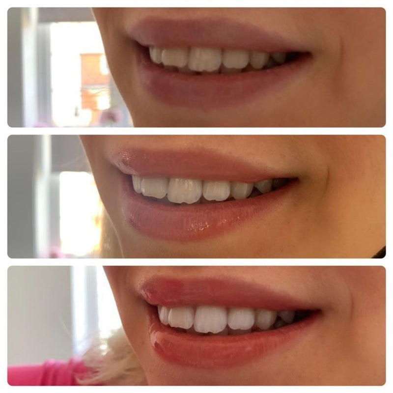 SmileTime Premium Teeth Whitening Kit